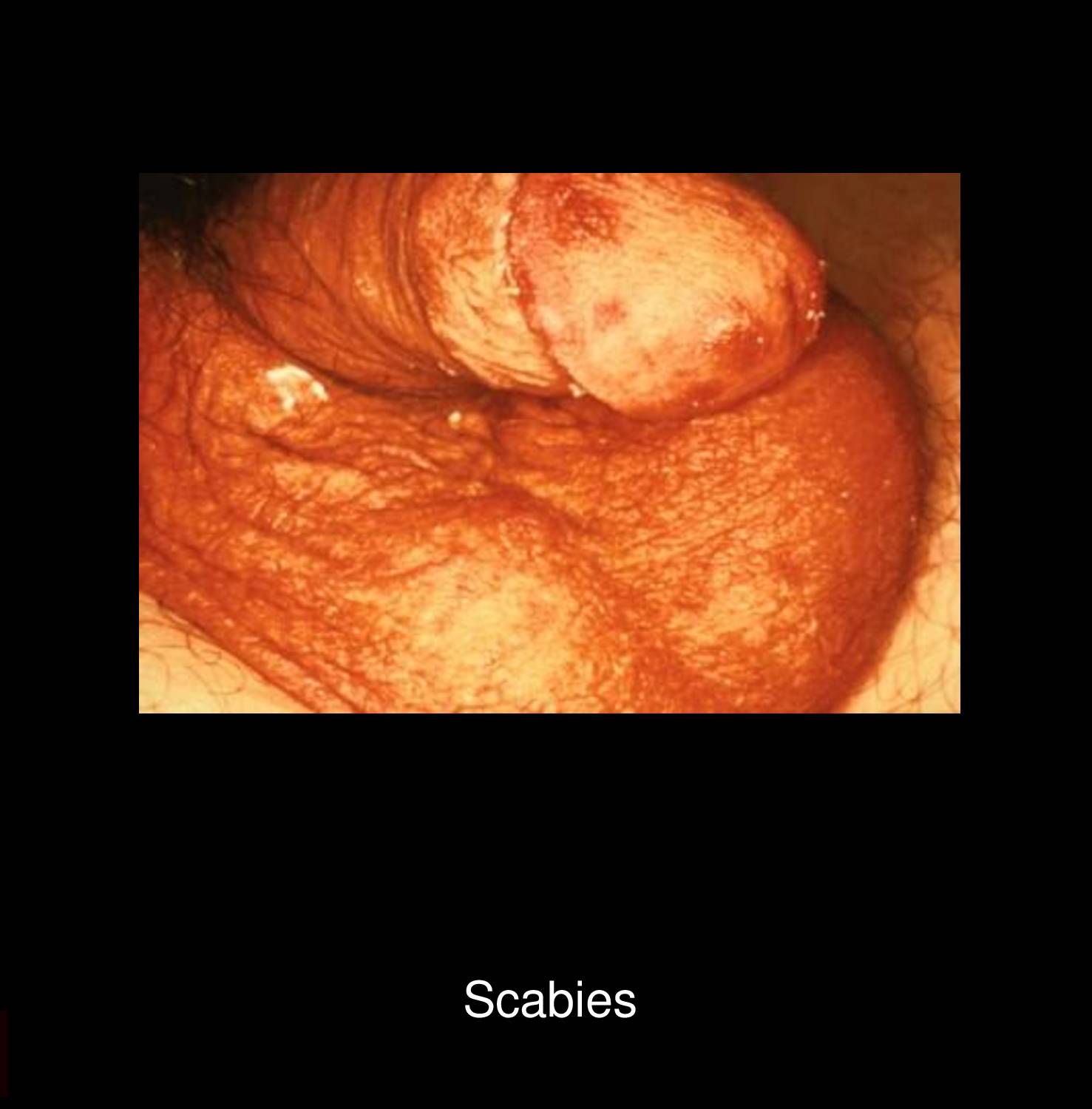 Generalized scabies rash on trunk showing widespread erythematous papules and excoriated lesions from Sarcoptes scabiei mite infestation
